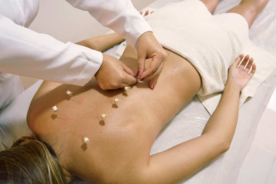 Acupuncture needles placed along the back